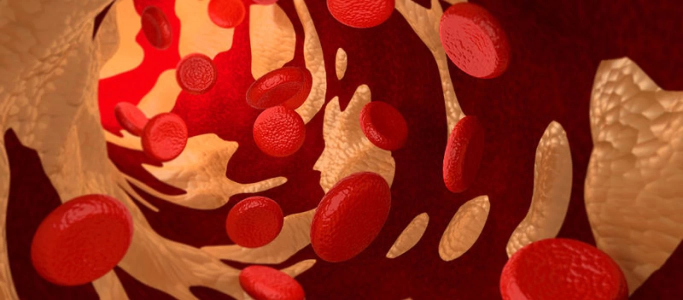 Χοληστερόλη: Τι πρέπει να τρώτε και τι να αποφεύγετε για να έχετε σωστή υγεία